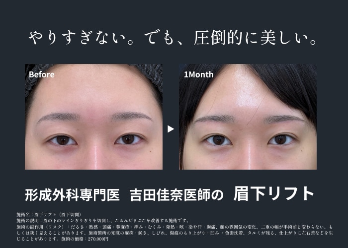 眉下リフトの期待できる効果は？